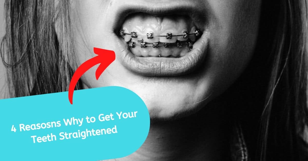 4 Reasosns Why to Get Your Teeth Straightened